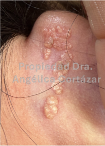 Nevo verrugoso, Paciente en DermaWise Clinica Dermatologica CDMX